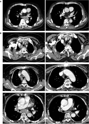 Neoadjuvant Immune Checkpoint Inhibitors Plus Chemotherapy in Locally Advanced Esophageal Squamous Cell Carcinoma: Perioperative and Survival Outcomes